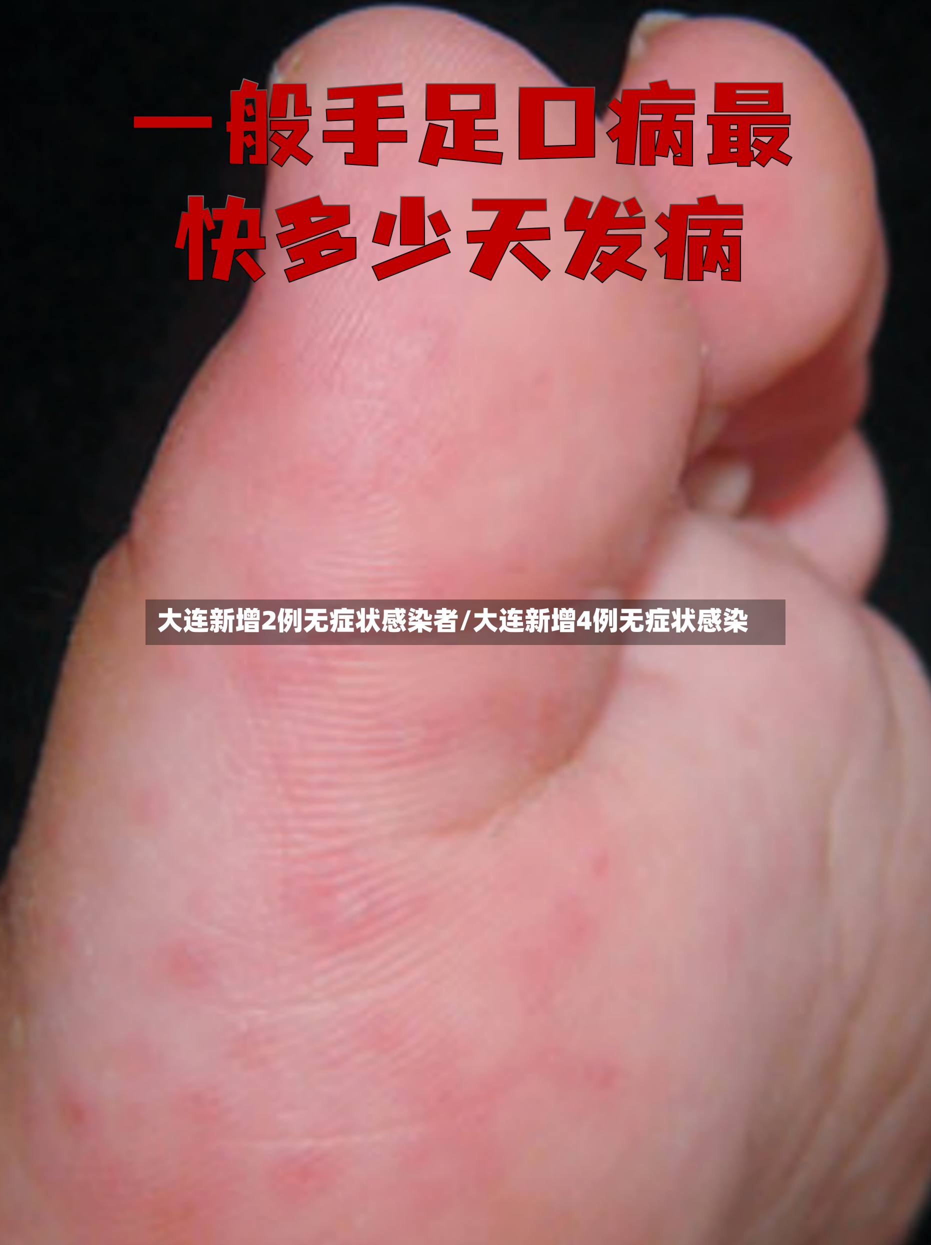 大连新增2例无症状感染者/大连新增4例无症状感染