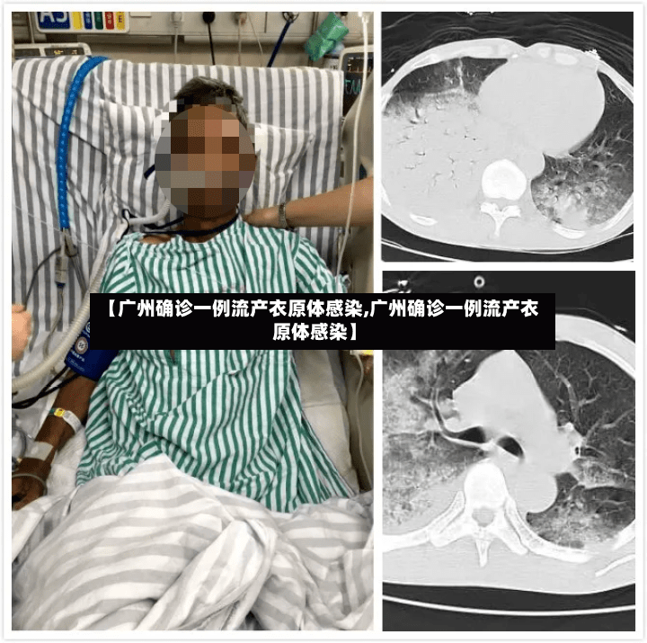 【广州确诊一例流产衣原体感染,广州确诊一例流产衣原体感染】